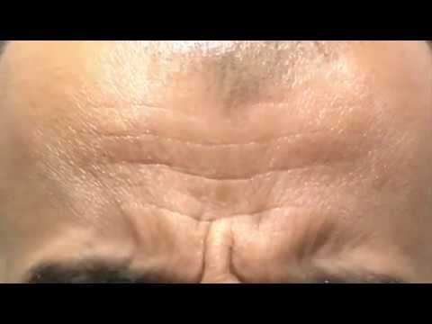 Brotox Frown Lines Before and After - Men's Botox Results.