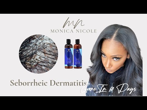 How I Finally Healed My Seborrheic Dermatitis In Just 10 Days!