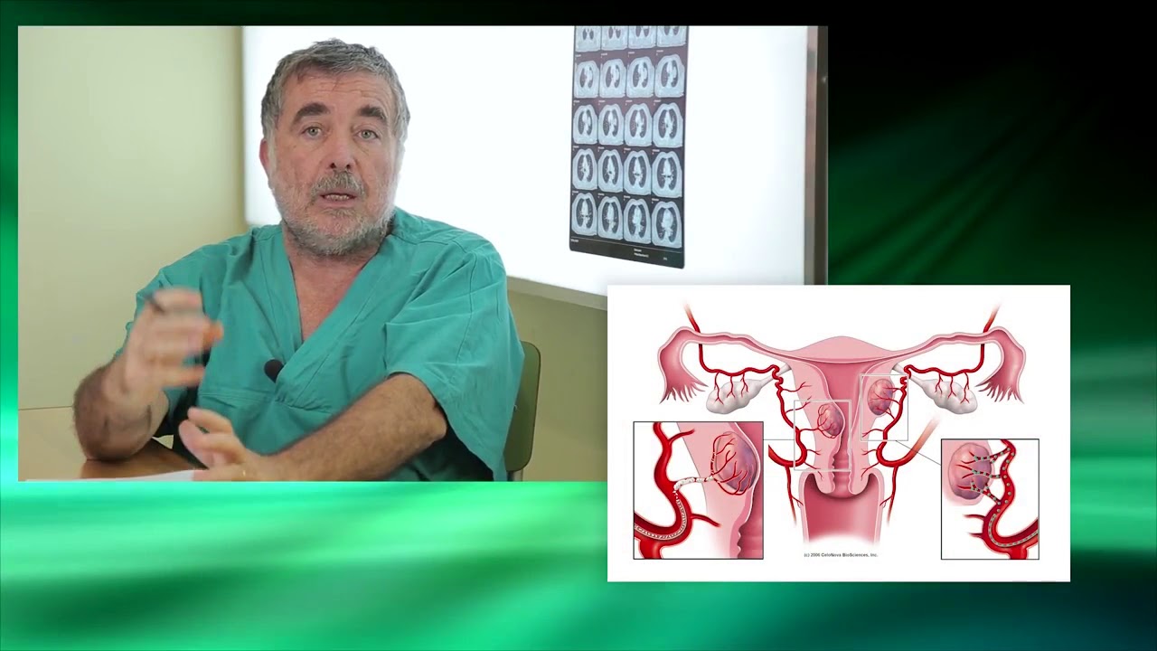 Radiologia Interventistica e trattamento del Fibroma Uterino