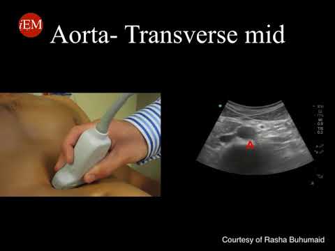 Video 17   Tutorial on ultrasound for abdominal aortic aneurysm