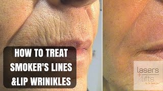 How to treat upper lip wrinkles and smoker