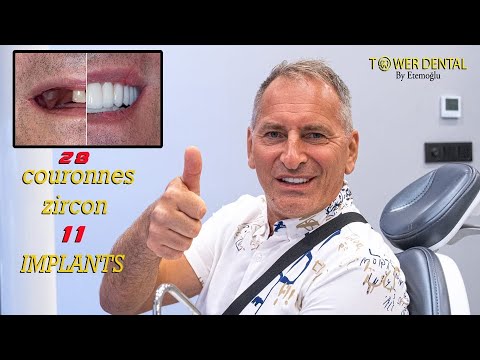 Perfect Smile Makeover: 11 Swiss Implants & 28 Zirconia Crowns in Turkey