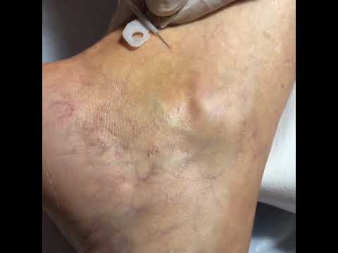 Sclerotherapy Treatment of our Bulgarian Patient
