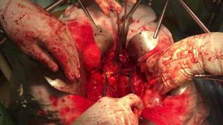 Download Lagu Redo Complex Aortic Surgery with Mesenteric bi-iliac by-pass, with Renal bypass for Ruptured FEVAR Thumbnail
