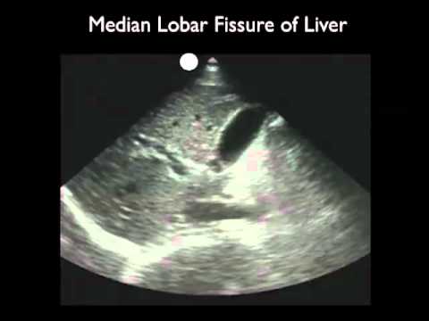 image-How do gallstones look in ultrasound?