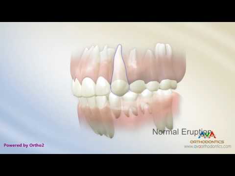 Malocclusion -  Ectopic Eruption of a Canine