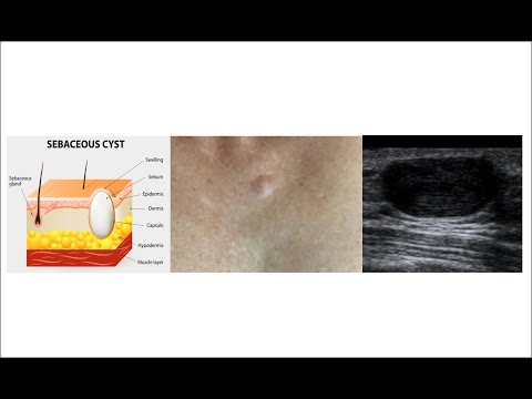 Ultrassonografia de cisto sebáceo na mama