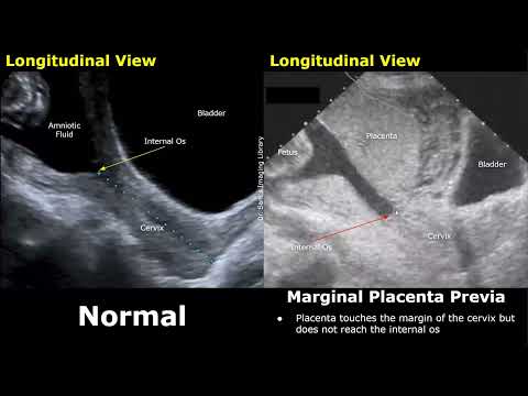Obstetric Ultrasound Normal Pregnancy Vs Placenta Previa | Low-Lying, Marginal, Partial, Complete