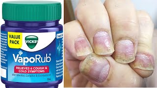 The ultimate solution for Nail Psoriasis: Vicks