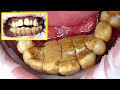 47 yo. Male's Teeth Gigantic Tartar Removal - Scaling