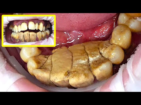 YouTube video about: How to remove dog teeth tartar?