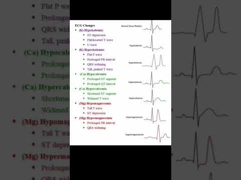 ECG Reading | ECG Changes | ECG Report  Understand very easily | #norcet2023 #hospitalstaff