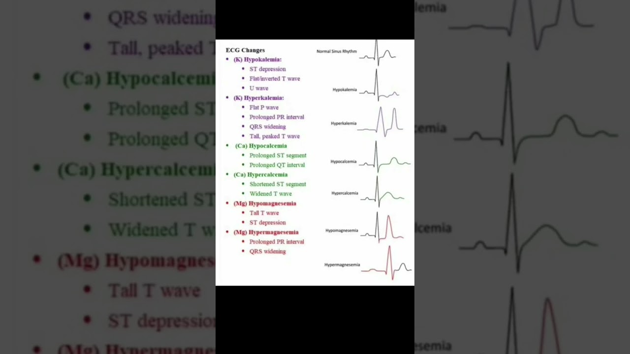 ECG Reading | ECG Changes | ECG Report  Understand very easily | #norcet2023 #hospitalstaff
