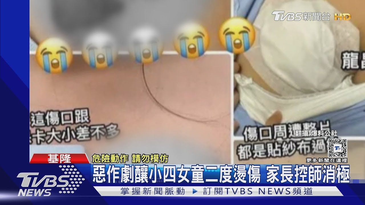 惡作劇釀小四女童二度燙傷 家長控師消極