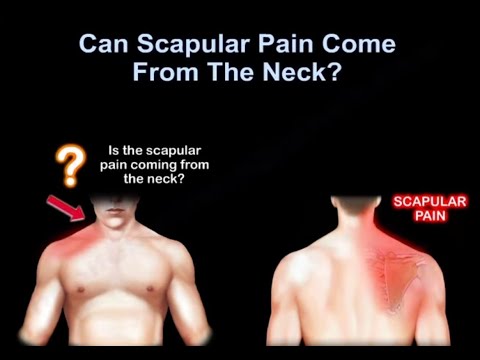 Can Scapular Pain Come From The Neck?