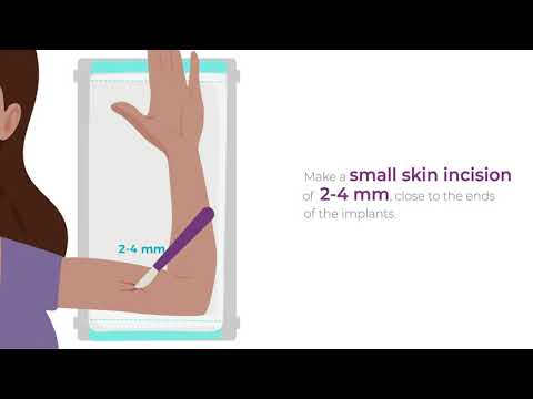 How to remove Levoplant™ contraceptive implants - video tutorial (English)