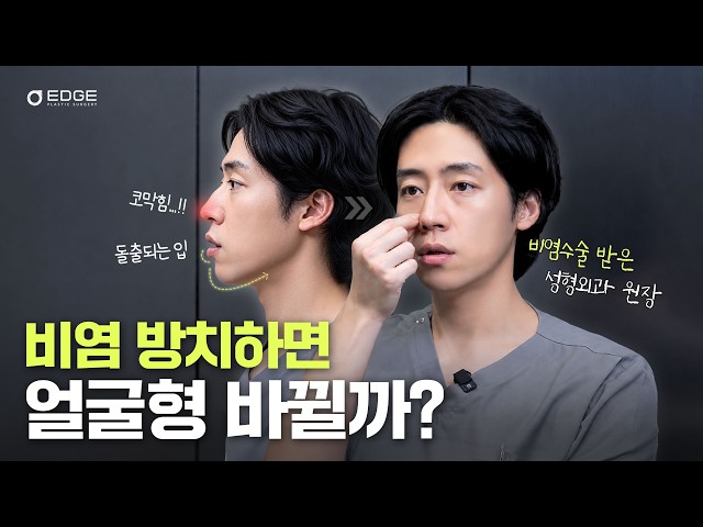 입으로 숨 쉬다 무턱까지? 얼굴 길어지는 이유가 비염 때문인 이유 입으로 숨 쉬다 무턱까지? 얼굴 길어지는 이유가 비염 때문인 이유 코성형