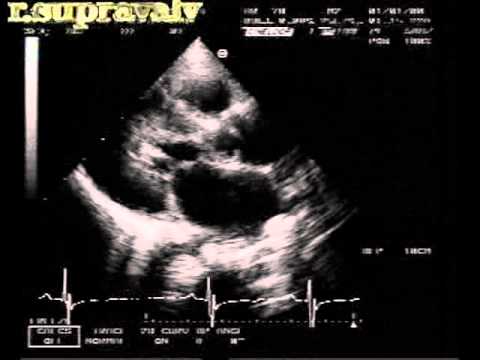 Supravalvular Aortic Stenosis: Focal Stenosis