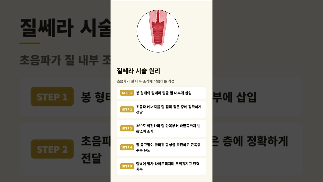 질쎄라 절개 없는 질 타이트닝!