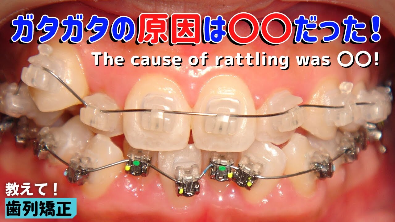 【歯列矯正】八重歯にでこぼこ歯列…どうして歯は歪んじゃうの？