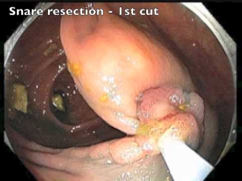 Resection of Flat Lesion on Ileocecal Valve