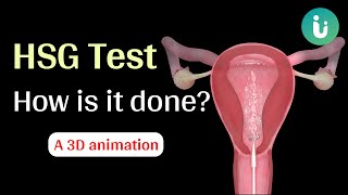 Download lagu What is HSG test and how is it done? A 3D medical animation mp3 Download lagu What is HSG test and how is it done? A 3D medical animation mp3