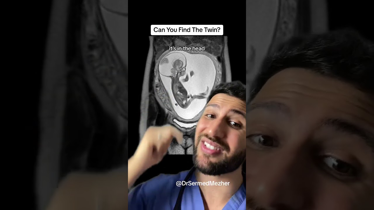 Can You Find the Twin? #pregnancy