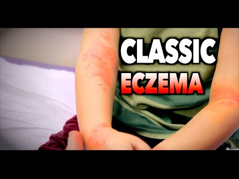 Le placche di psoriazny che trattare Unguento di dermatite di atopic sulla testa