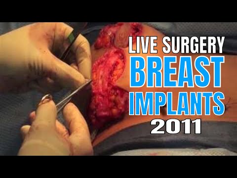 breast lift with breast implants, live Utah plastic surgery video.