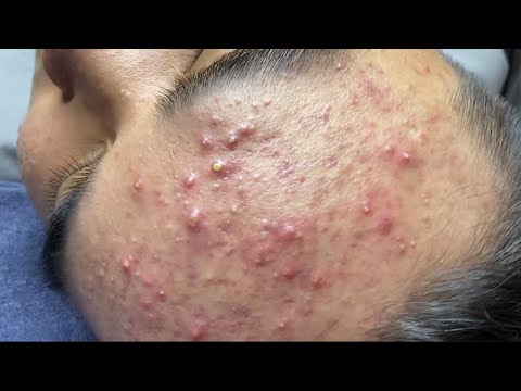 Ultimate Blackhead Removal ASMR | Relaxing Skin-Care Session