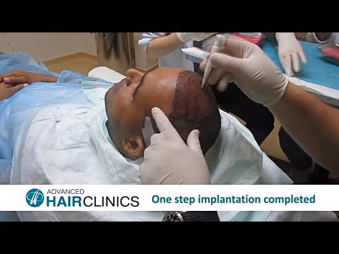FUE Hair Transplantation: Step-by-Step by Dr.