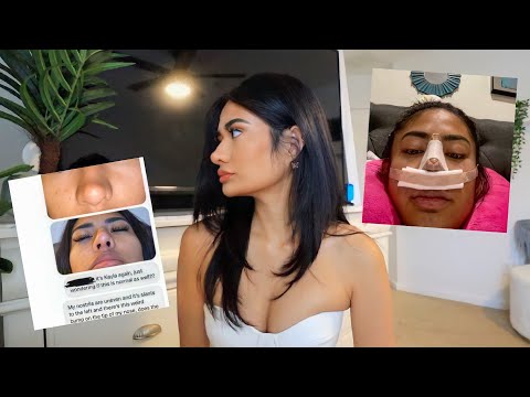 why my $19k nose job wasn't worth it...| RECOVERY, PHOTOS, EXPERIENCE