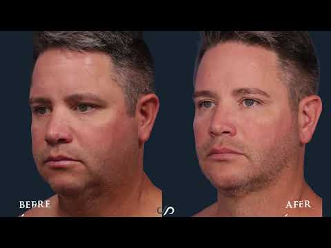 FACIAL CONTOURING | Buccal Fat reduction + Liposuction + Chin Augmentation Dr. David Stoker
