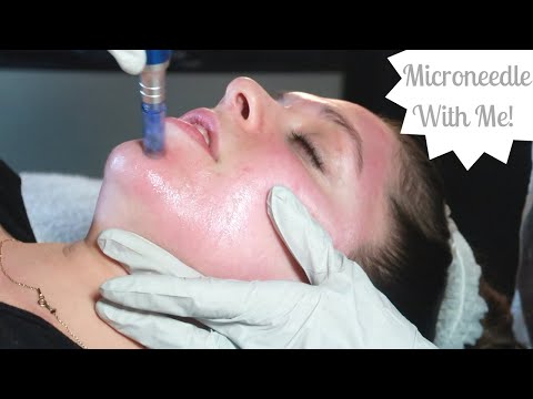 I tried MICRONEEDLING on my face! Is it worth it? Everything You Need To Know! Video