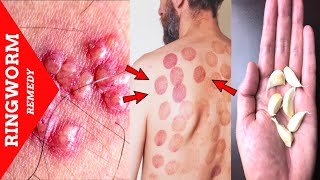 How to Get Rid of Ringworm With Garlic | Ringworm Treatment At Home .
