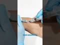 3/3 Treatments for Wrist Ganglion Cysts