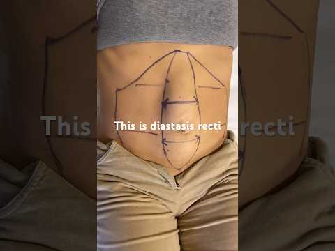 This is a case of #diastasisrecti , Dr. Darecchio is the creator of this scarless robotic technique
