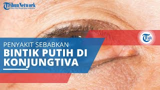 Pinguecula, Penyakit Mata yang Membuat Penderitanya Mengalami Bintik Putih di Sekitar Konjungtiva