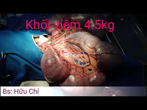 Viêm tử cung(khối viêm 4.5kg) Bs: Nguyễn Hữu Chí