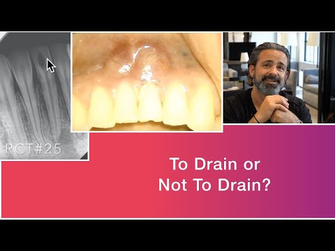 LIVE GentleWave Root Canal Procedure Lower Anterior (HD)