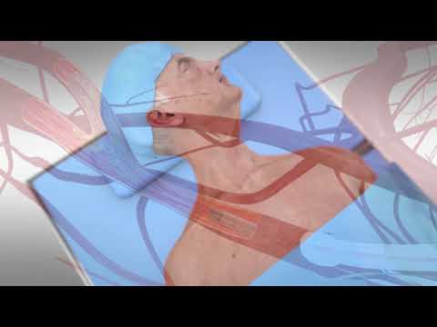 TCAR or transcarotid artery revascularization procedure