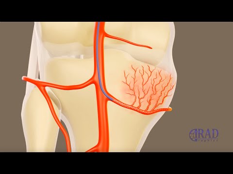 Genicular Artery Embolization for Osteoarthritis