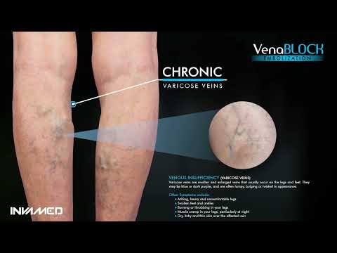 VenaBlock Treatment