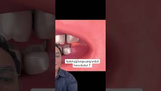Download lagu Menurut kalian gigi bungsu harus dicabut ? Video berikutnya aku kasih tau jawaban beserta alasanya mp3