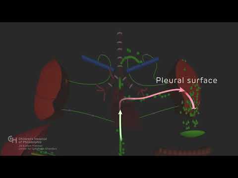 Chylothorax | Children
