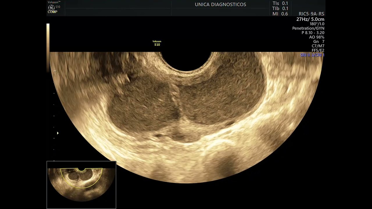 Vídeos de exames de endometriose Pt. 3