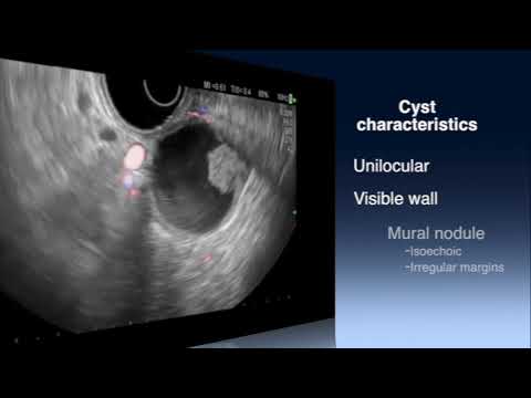EUS of mural nodule in pancreas cystic tumor by Dr. Dario Ligresti