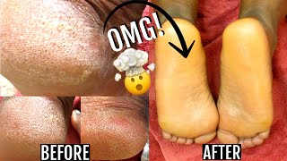 HOW TO TREAT DRY, CRACKED FEET FAST & NATURALLY AT HOME | BEST FOOT BUTTER GET RID OF CALLUS FAST