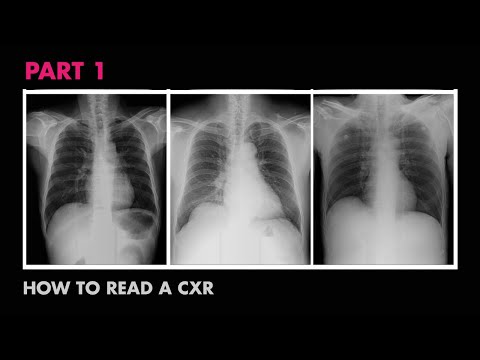Anatomy of a Chest X-Ray - How to Read a Chest X-Ray (Part 1)
