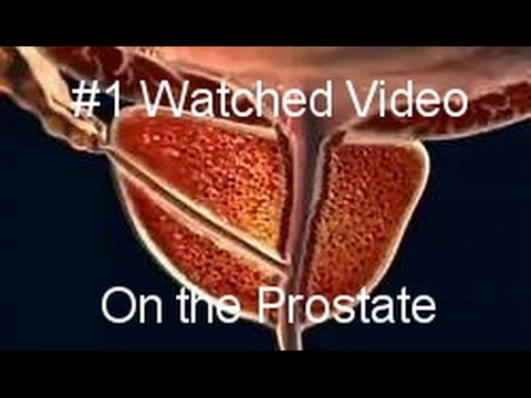 Felsige Prostata Dichte Entzündung des Fiebers Prostata-Adenom